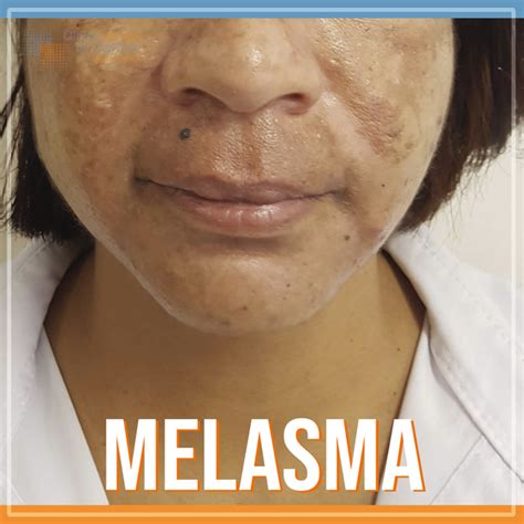 Perguntas Frequentes Sobre Melasma