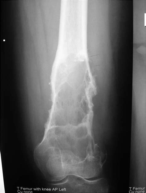 Fibrosarcoma Of Bone Portnotes