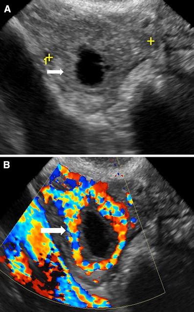 A Transvaginal Ultrasound Of The Right Ovary In A 32 Year Old Woman Download Scientific Diagram