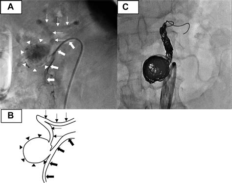 Endovascular Coil Embolization For An Anomalous Splenic Artery Aneurysm With A Splenomesenteric