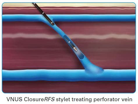 Vein & Vascular Treatment | Perforator Vein