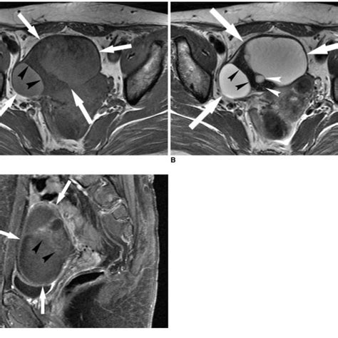 A 42 Year Old Woman With A Mucinous Cystadenofibroma The T1 A And