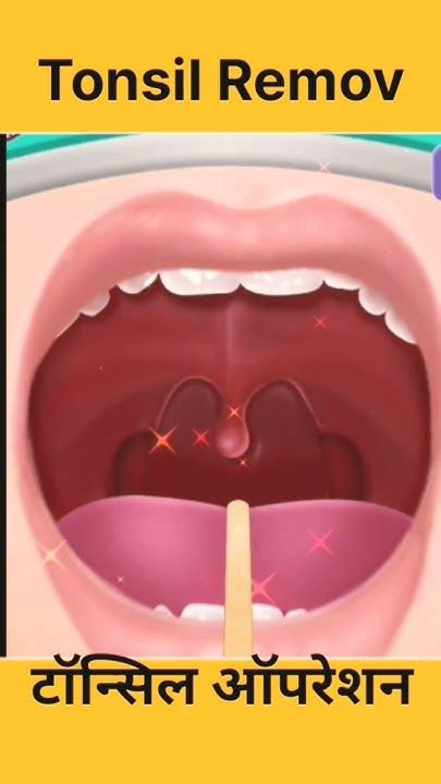 Tonsil Stones Remove Youtube