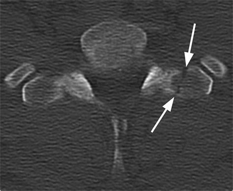 Section 3 Trauma To Uncompromised Spine Radiology Key