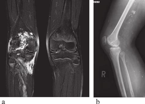 A 20s Year Old Female With Diffuse Venous Malformation Of The Right Download Scientific