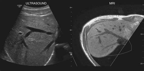 Ultrasound of the liver, biliary tract, and pancreas | Ultrasound ...