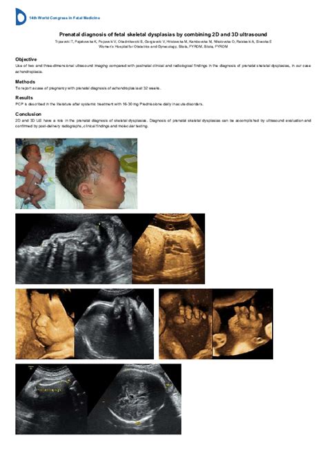 Achondroplasia Ultrasound