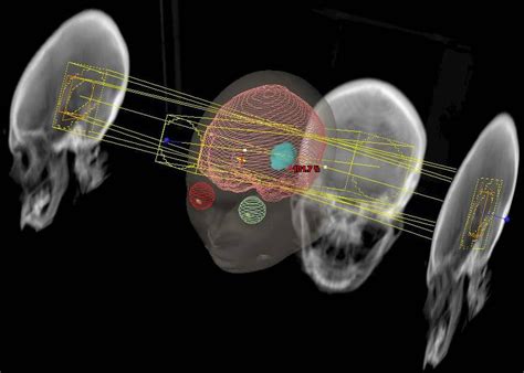 Radiation Therapy For Brain Cancer - All About Radiation