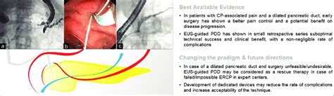 EUS Guided Pancreatic Duct Drainage A EUS Guided Transgastric Access