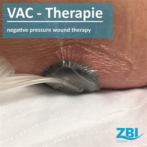 Vac Therapie Unterdruck Wundtherapie So Geht S Zbi Gruppe