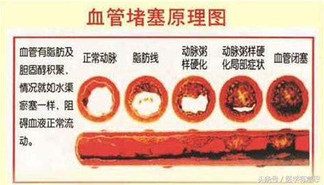 身體出現這五個信號要小心，你的血管開始堵塞了 Ifuun