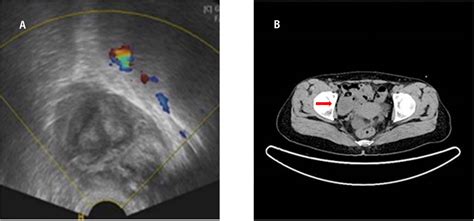 Giant Appendiceal Mucocele Mimicking An Ovarian Tumour Bmj Case Reports