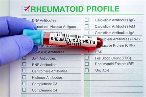 How Is Rheumatoid Arthritis Diagnosed? | Empowered Arthritis and ...