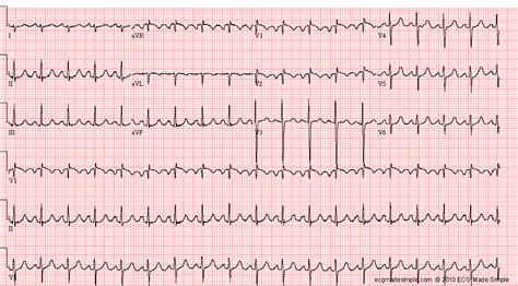 Case 9 A 42 Year Old Woman With Heart Failure ECG Made Simple