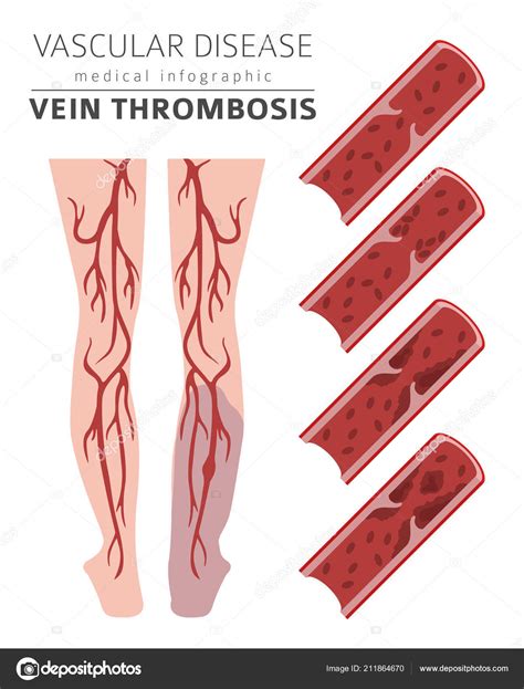 Vascular Diseases Vein Thrombosis Symptoms Treatment Icon Set Stock