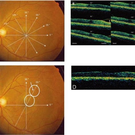 Peeling Of The Posterior Hyaloid Membrane A Creating An Opening At