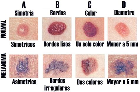 Descubre Cuantos Tipos De Lunares Existen Y C Mo Vas De Salud