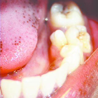 Orthopantomograph Showing Submerged Mandibular Primary Left Second