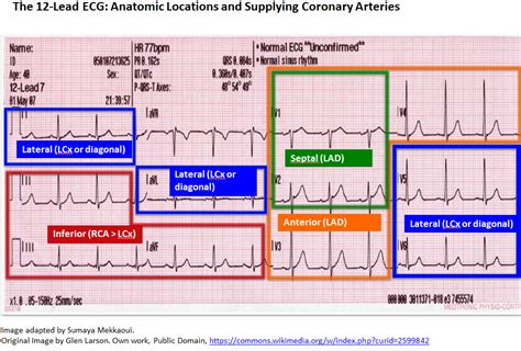 Ecg Interpretation Review 13 Bbb Wide Qrs Is This Lbbb Vs Rbbb Vs Ivcd Artofit