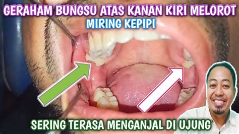 Geraham Bungsu Atas Kiri Kanan Tumbuh Melorot Dan Miring Kepipi Youtube