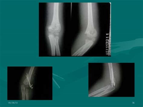 Fractura Supracond Lea Intercond Lea Humeral Ppt