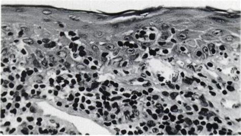 Photomicrograph Of A Skin Biopsy Showin And Large Lymphocytes With Download Scientific Diagram