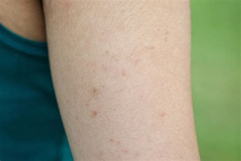 Ever Wonder Why You Get Those Weird Little Red Bumps On Your Arms Summer Is Coming