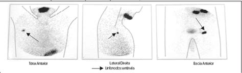 Rbcp Sentinel Lymph Node Mapping In Patients With Cutaneous Melanoma