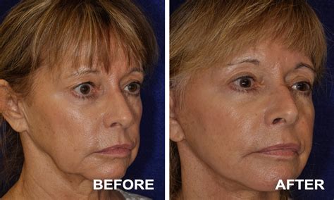 Gallery Facial Procedures Dr Marshak In Palm Desert