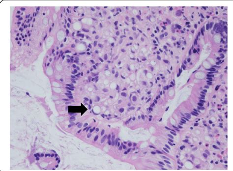 Hematoxylin And Eosin He Staining He Staining Of The Biopsy Samples