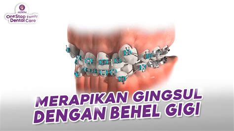 CARA MERAPIKAN GIGI GINGSUL DENGAN BEHEL GIGI YouTube