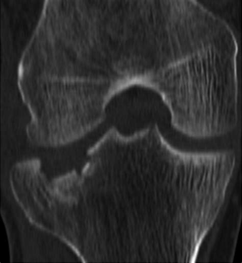 Schatzker Classification Of Tibial Plateau Fractures Use Of Ct And Mr Imaging Improves