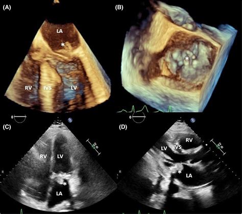 Threedimensional Transesophageal Echocardiography Showing Mobile