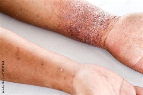 Atopic Dermatitis Ad Also Known As Atopic Eczema Is A Type Of