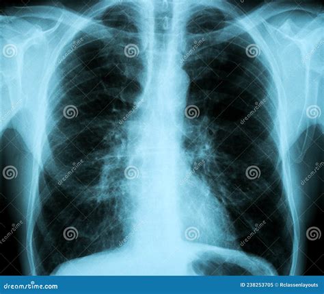 X Ray Image Of Human Healthy Chest Mri Stock Image Image Of Anatomy