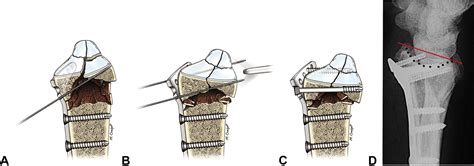 Arthroscopic Reduction Of Comminuted Intra Articular Distal Radius