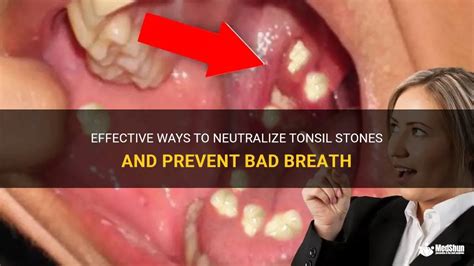 Effective Ways To Neutralize Tonsil Stones And Prevent Bad Breath Medshun