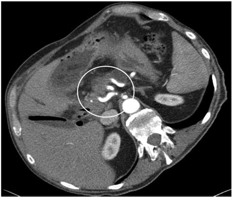 Cancers Free Full Text Current State Of Surgical Management Of Pancreatic Cancer