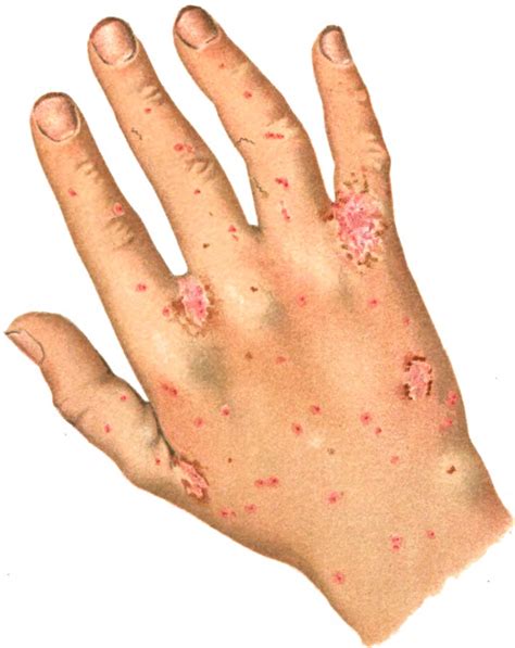 File:An introduction to dermatology (1905) scabies.jpg - Wikimedia Commons