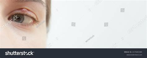 Painful Red Upper Eyelid Onset Stye Stock Photo 2175403385 | Shutterstock