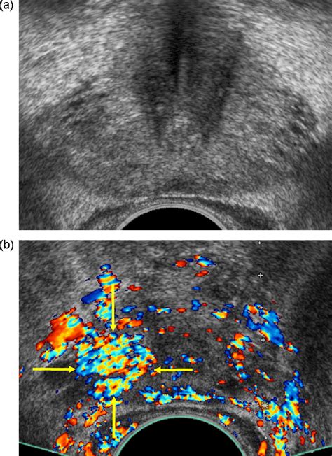 Contrast Enhanced Ultrasound For Diagnosis Of Prostate Cancer And