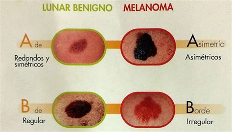 Lunares Benignos Y Malignos Cuadros Sin Pticos Cuadros Comparativos