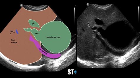 Choledochal Cyst Sonographic Tendencies