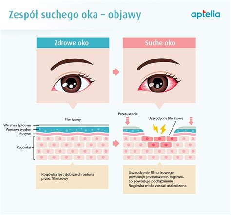 Zespół suchego oka objawy ZSO przyczyny i sposoby leczenia aptelia pl