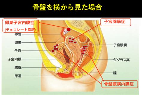 子宮内膜症｜ウイメンズクリニック南麻布 清水敬生｜港区 南麻布の婦人科。