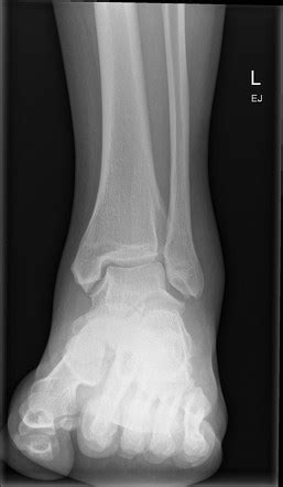 Anterior Calcaneal Process Fracture Radiology Case Radiopaedia Org