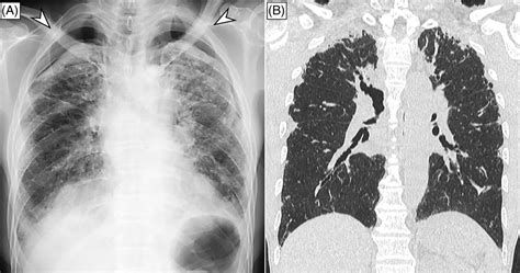 Apical Pneumothorax