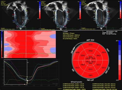 Acquisition Of Global Longitudinal Strain And Depiction Of Segmental