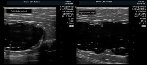 Ultrasound image showing two simulated subcutaneous abscess cavities (4 ...