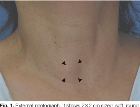 Figure 1 From A Case Of Unusual Type Of Branchial Cleft Cyst Presenting